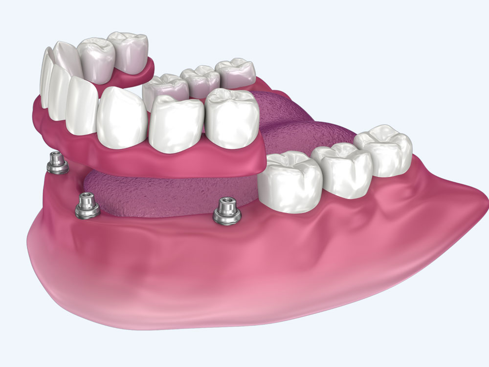 4 Implants Houston
