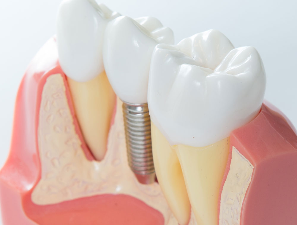 Dental implants Houston