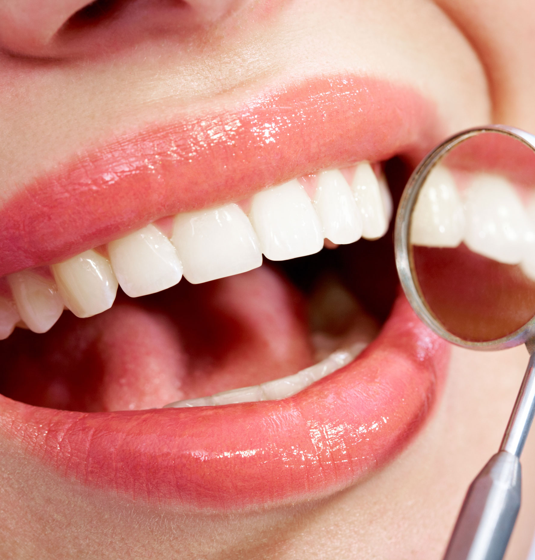 veneers in houston