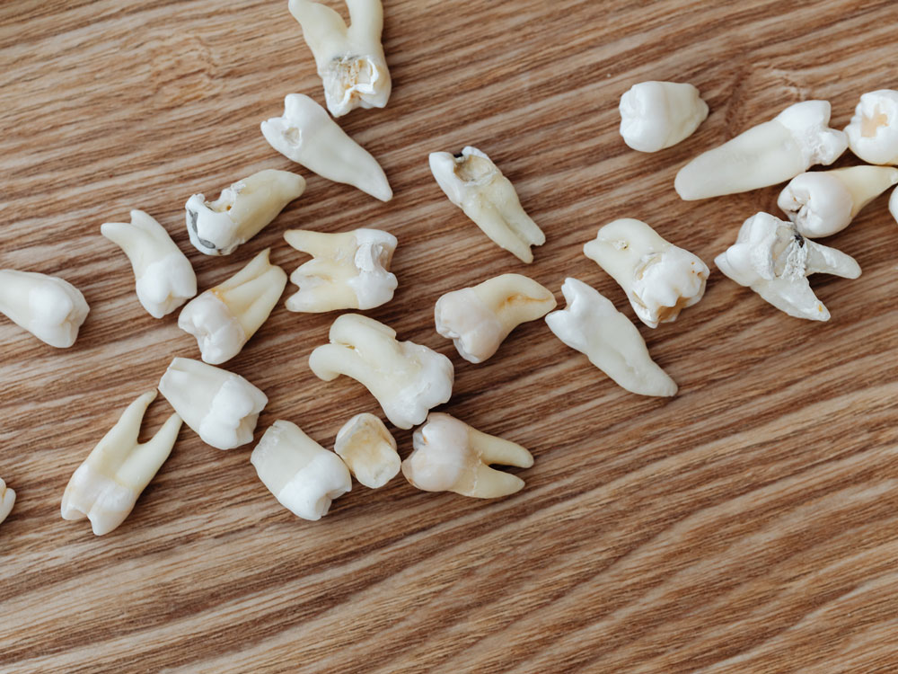 tooth extraction houston