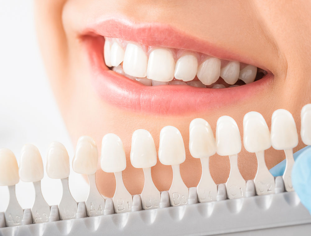 tooth whitening houston